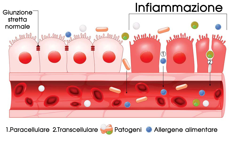 diagram showing leaky gut infiammazione intestinale